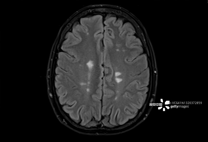 多發(fā)性腦硬化癥的磁共振成像，軸位Flair視圖