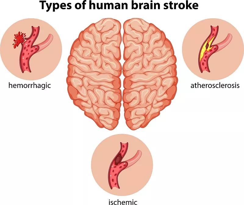 人類大腦中風的類型