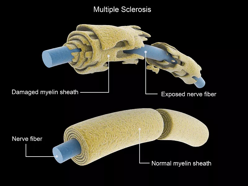 多發(fā)性硬化癥神經(jīng)元與正常神經(jīng)元的比較