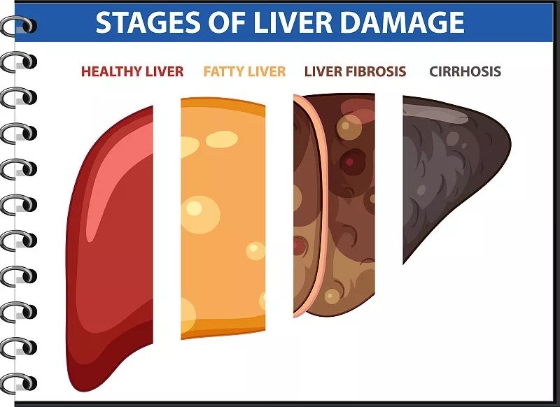 肝臟損傷分期圖