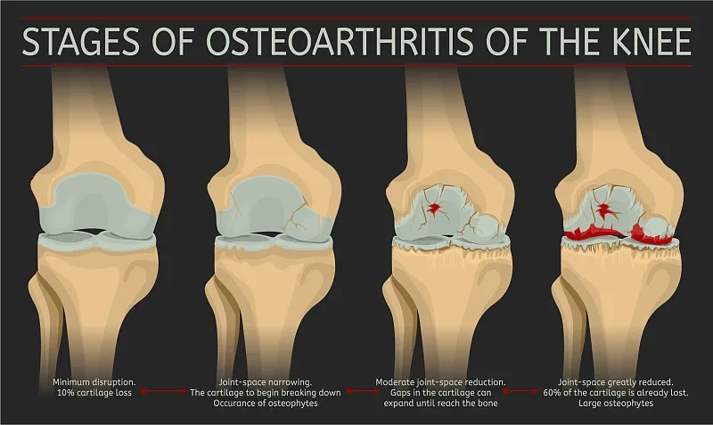 膝關(guān)節(jié)骨關(guān)節(jié)炎的分期
