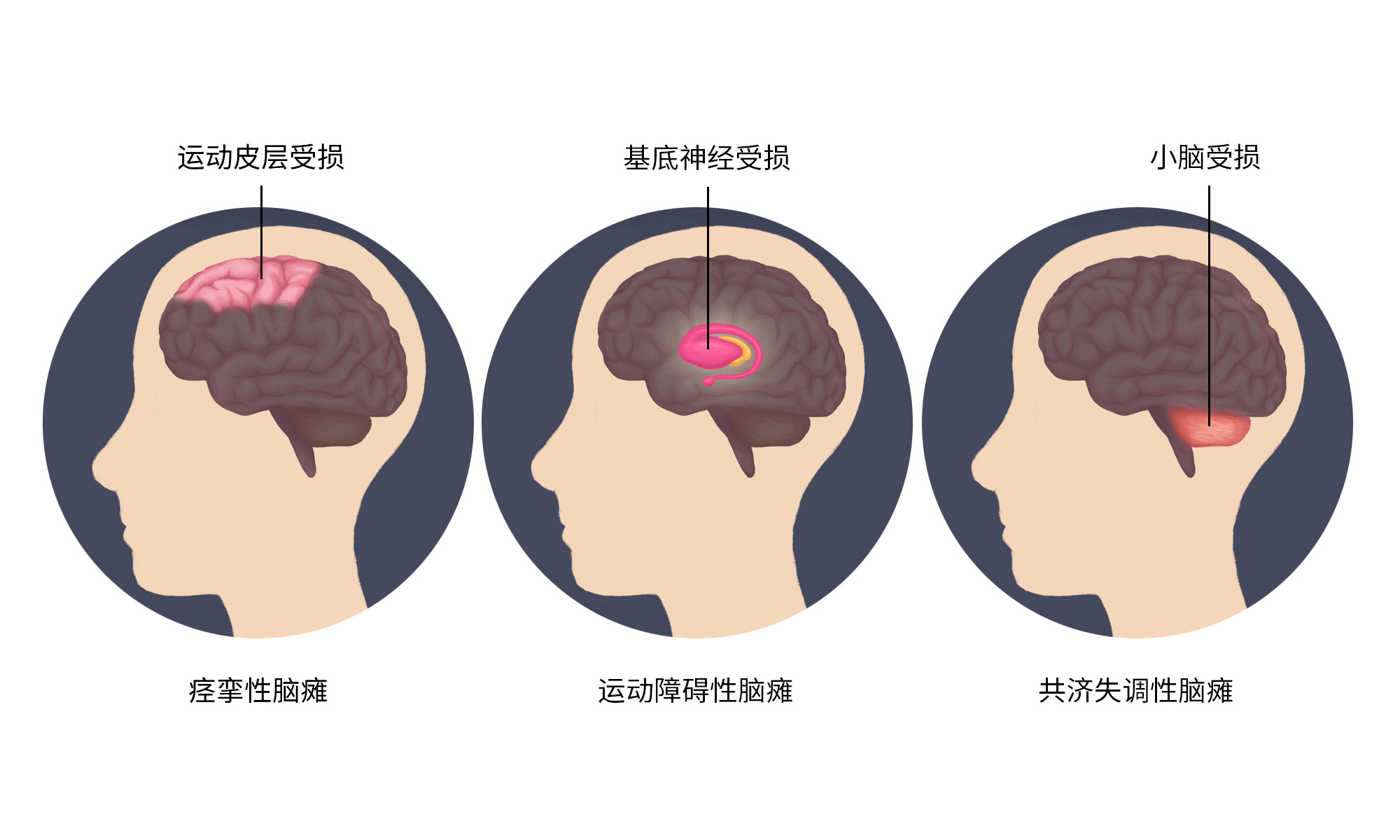 引起腦性癱瘓的大腦受損部位不同導(dǎo)致癥狀不同