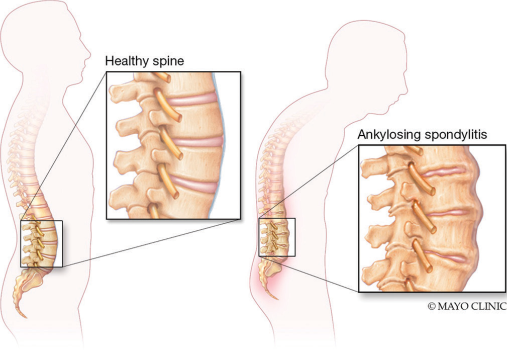 強(qiáng)直性脊柱炎的類(lèi)型和階段