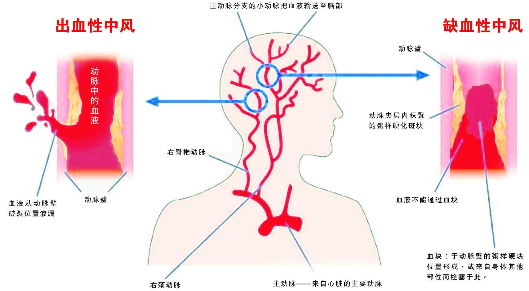 干細(xì)胞治療腦卒中的臨床試驗研究進展