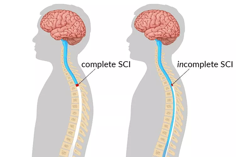 不完整和完整的脊髓損傷有什么區(qū)別