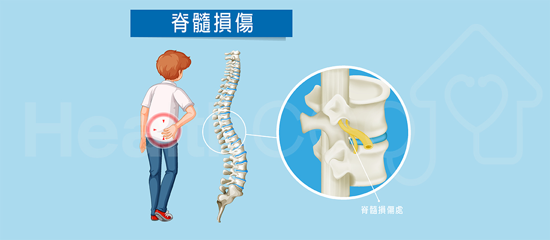 不同類(lèi)型不完全性脊髓損傷的最佳治療方法