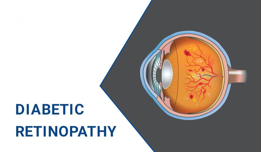 糖尿病視網(wǎng)膜病變–原因、階段和治療