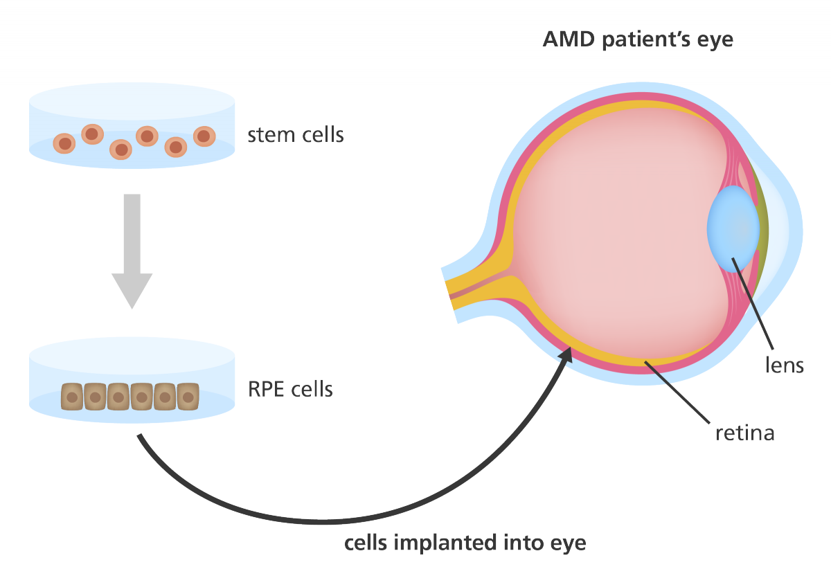插圖顯示干細胞如何用于產(chǎn)生可用于治療年齡相關(guān)性黃斑變性 (AMD) 患者的視網(wǎng)膜色素上皮 (RPE) 細胞