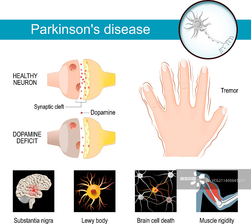 帕金森病的信息圖癥狀