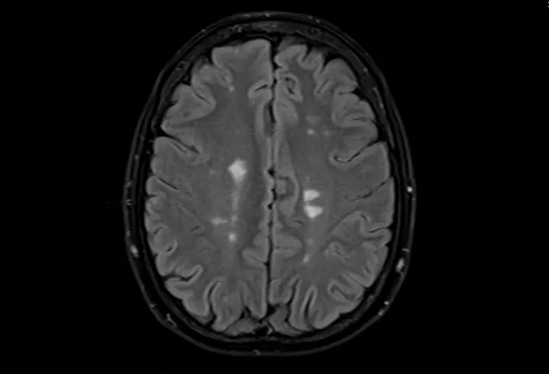 多發(fā)性腦硬化癥的磁共振成像，軸位Flair視圖