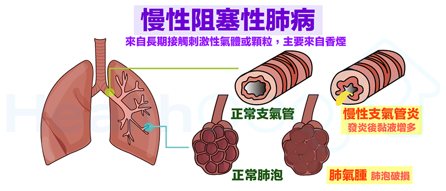 使用干細(xì)胞治療慢性阻塞性肺病的一例病例