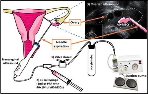 圖1：PRP+AD-MSCs在卵巢中的應(yīng)用；
