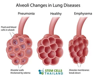 肺泡再生干細(xì)胞肺氣腫再生