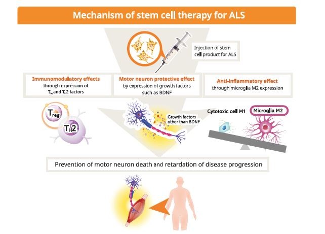 干細胞療法用于治療肌萎縮側(cè)索硬化癥（ALS）。