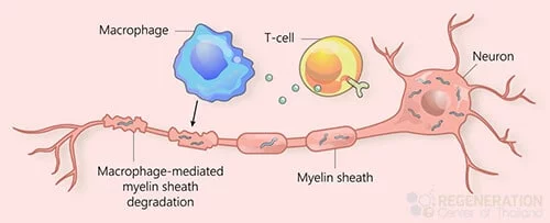 肌萎縮側(cè)索硬化癥 (ALS)、運動神經(jīng)元疾病 (MND)