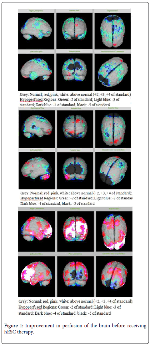 圖1：接受hESC治療前大腦灌注的改善。