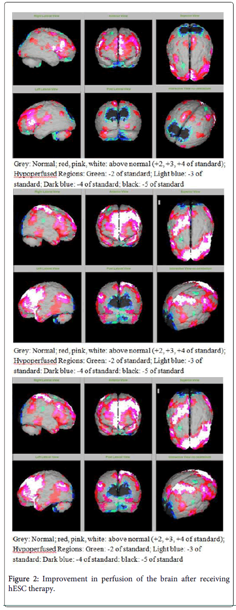 圖2：接受hESC治療后大腦灌注得到改善