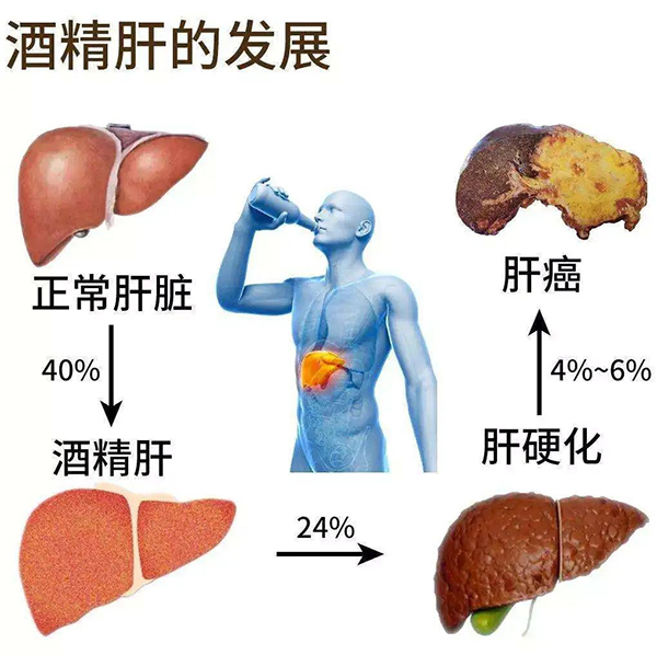 酒精相關(guān)肝病的癥狀