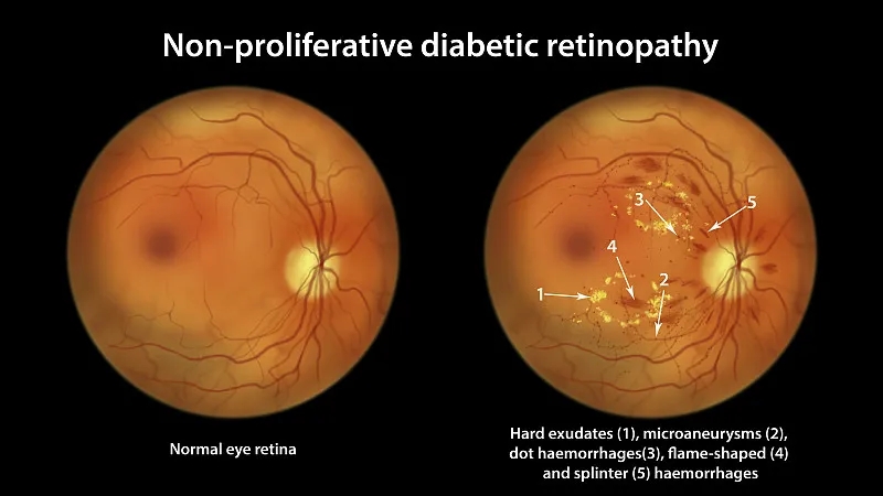 糖尿病視網(wǎng)膜病變綜合指南：治療及更多內(nèi)容