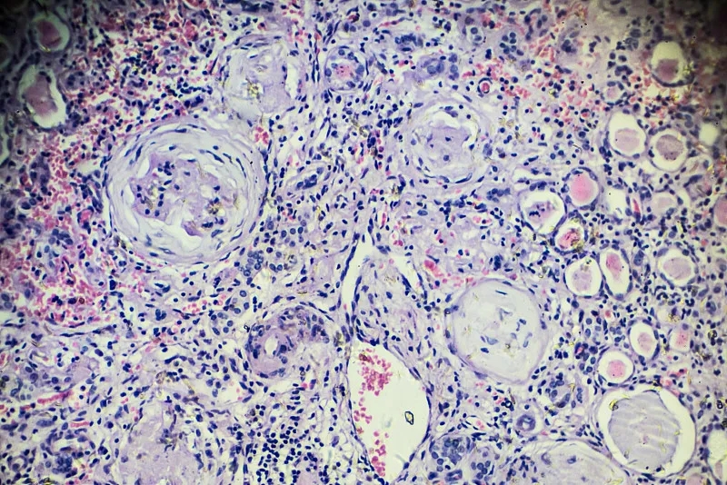 研究：自體干細胞移植對多發(fā)性骨髓瘤、慢性腎病患者安全有效