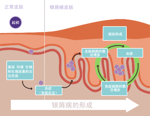 銀屑病治愈：是科學(xué)事實還是虛假希望？