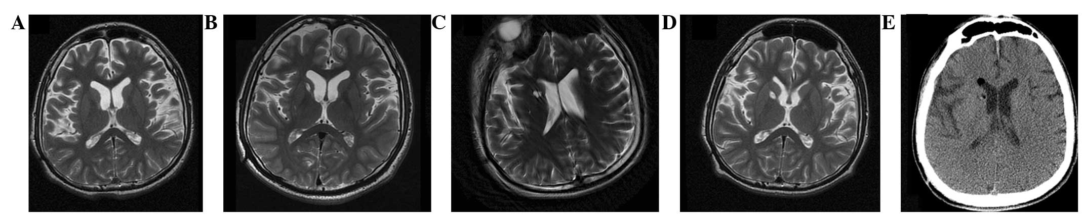 圖2：-T2加權(quán)磁共振成像 (MRI)