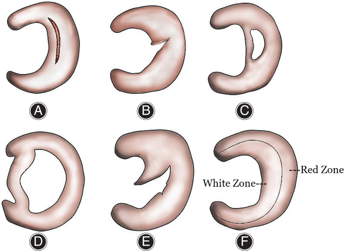圖2：半月板的解剖結(jié)構(gòu)和損傷類(lèi)型