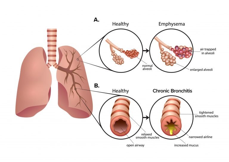 圖2：慢性阻塞性肺疾病 (COPD) 是一組導(dǎo)致呼吸困難的肺部疾病。A.肺氣腫導(dǎo)致肺泡氣囊受損和僵硬。空氣被困在肺泡中，導(dǎo)致呼氣困難。B.慢性支氣管炎會(huì)導(dǎo)致氣道腫脹和粘液增多。多余的粘液使呼吸困難并導(dǎo)致慢性咳嗽