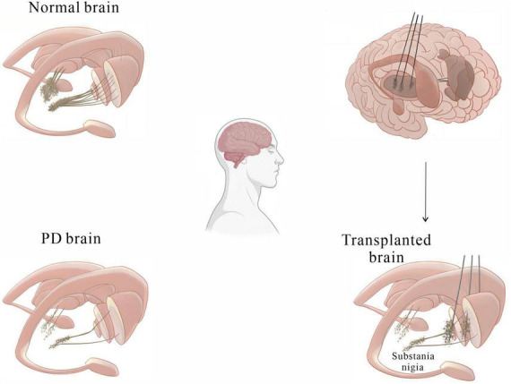 圖2：基本圖顯示細(xì)胞移植療法如何緩解帕金森病患者的運(yùn)動(dòng)癥狀。