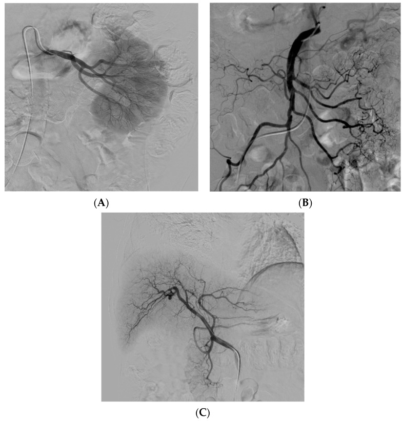 圖2：腎 (?A?)、腸系膜上動(dòng)脈 (?B?) 和肝動(dòng)脈 (?C?) 的血管造影插管