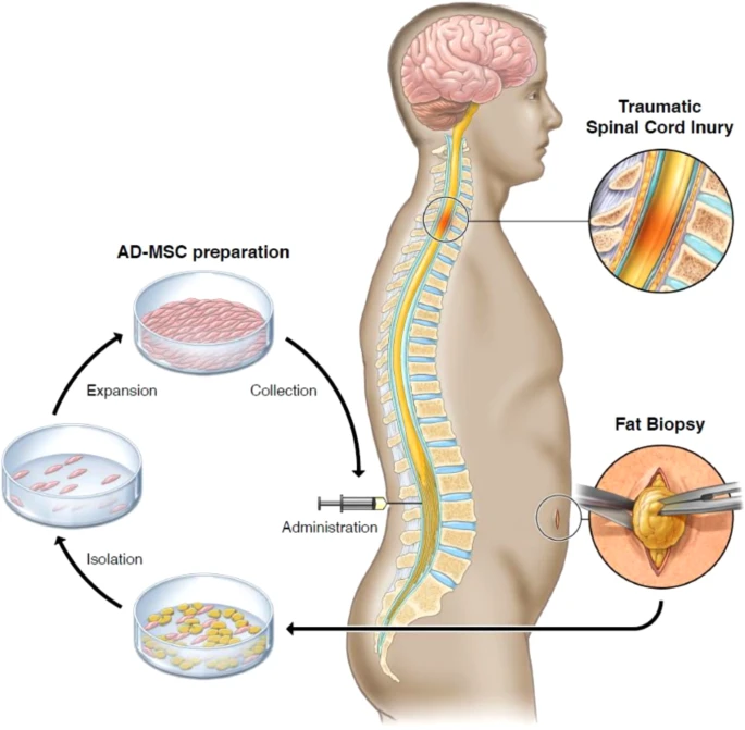 通過活檢、AD-MSC 分離、擴(kuò)增和收集以及治療管理來獲取脂肪的過程圖解
