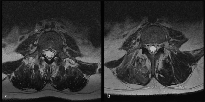 6號(hào)患者腰椎T2加權(quán)磁共振成像 (MRI) 的軸向視圖，該患者在L4-S1輸注后出現(xiàn)馬尾夾緊。L4水平的輸注前 MRI 掃描。b1年隨訪時(shí)L4水平的輸注后 MRI掃描。