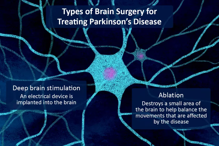 帕金森病的腦部手術(shù)：類(lèi)型、恢復(fù)和風(fēng)險(xiǎn)