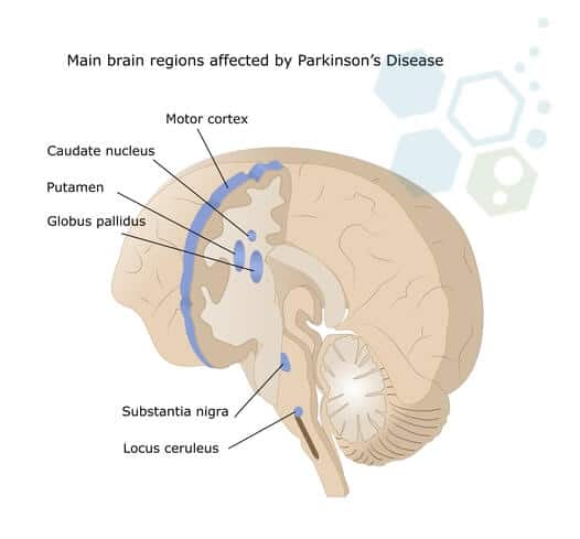 帕金森病影響區(qū)域