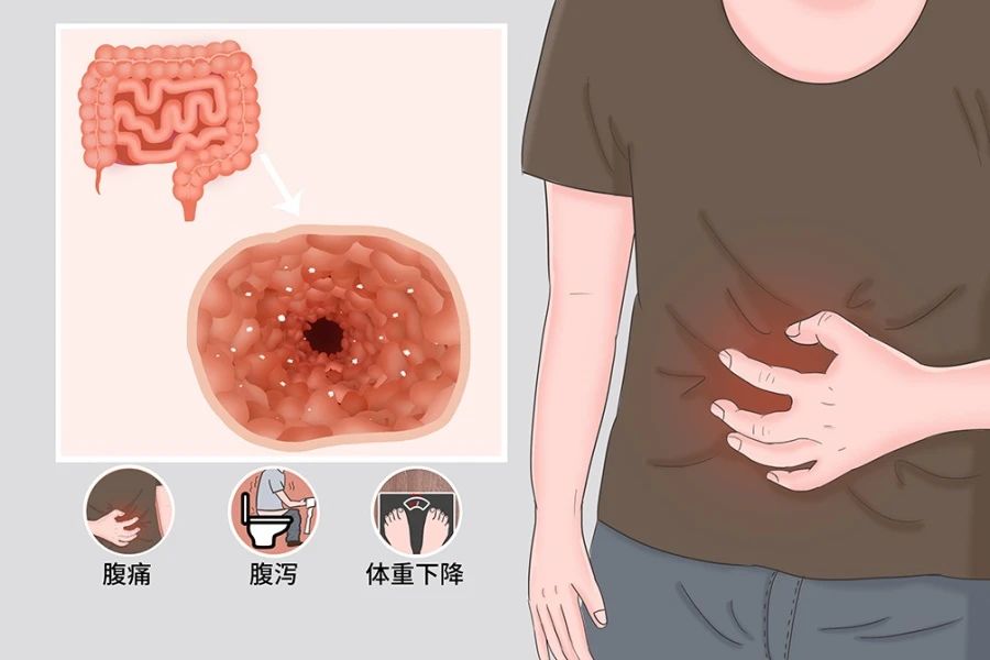 中山大學(xué)醫(yī)院：8例克羅恩病患者在干細(xì)胞治療后，臨床癥狀和體征顯著改善