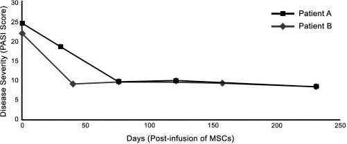 圖 1?. 移植 MSCs 前后兩例患者的銀屑病面積和嚴重程度指數(shù) (PASI) 評分總結(jié)。在輸注 MSCs 后的隨訪中，每例患者的 PASI 評分均有所下降。評分由第三方皮膚科醫(yī)生進行。臨床改善持久，患者 A 的改善持續(xù)超過 150 天，患者 B 的改善持續(xù)超過 200 天。