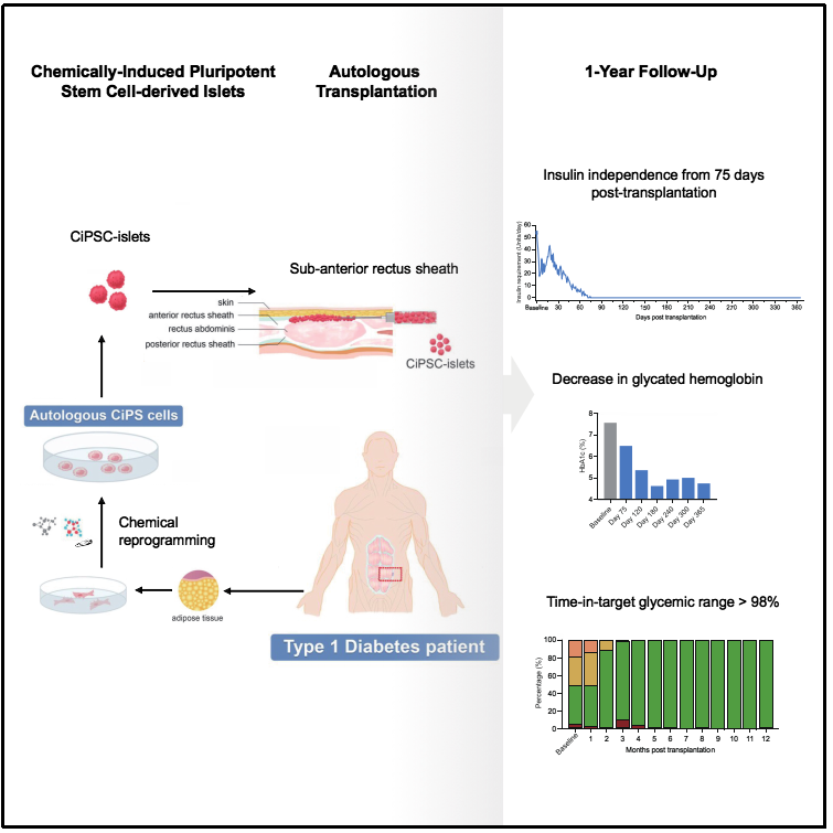 圖1：基于CiPS細胞治療1型糖尿病的臨床研究的示意圖和治療效果