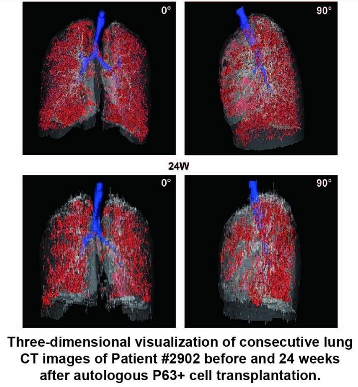 患者#2902在自體P63+細(xì)胞移植前后24周連續(xù)肺部CT圖像的三維可視化。
