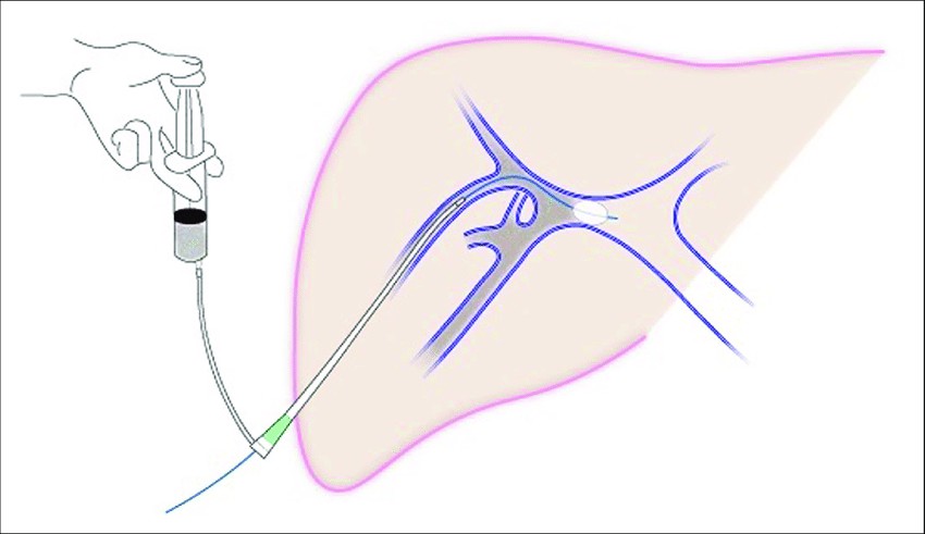 肝門(mén)靜脈輸注